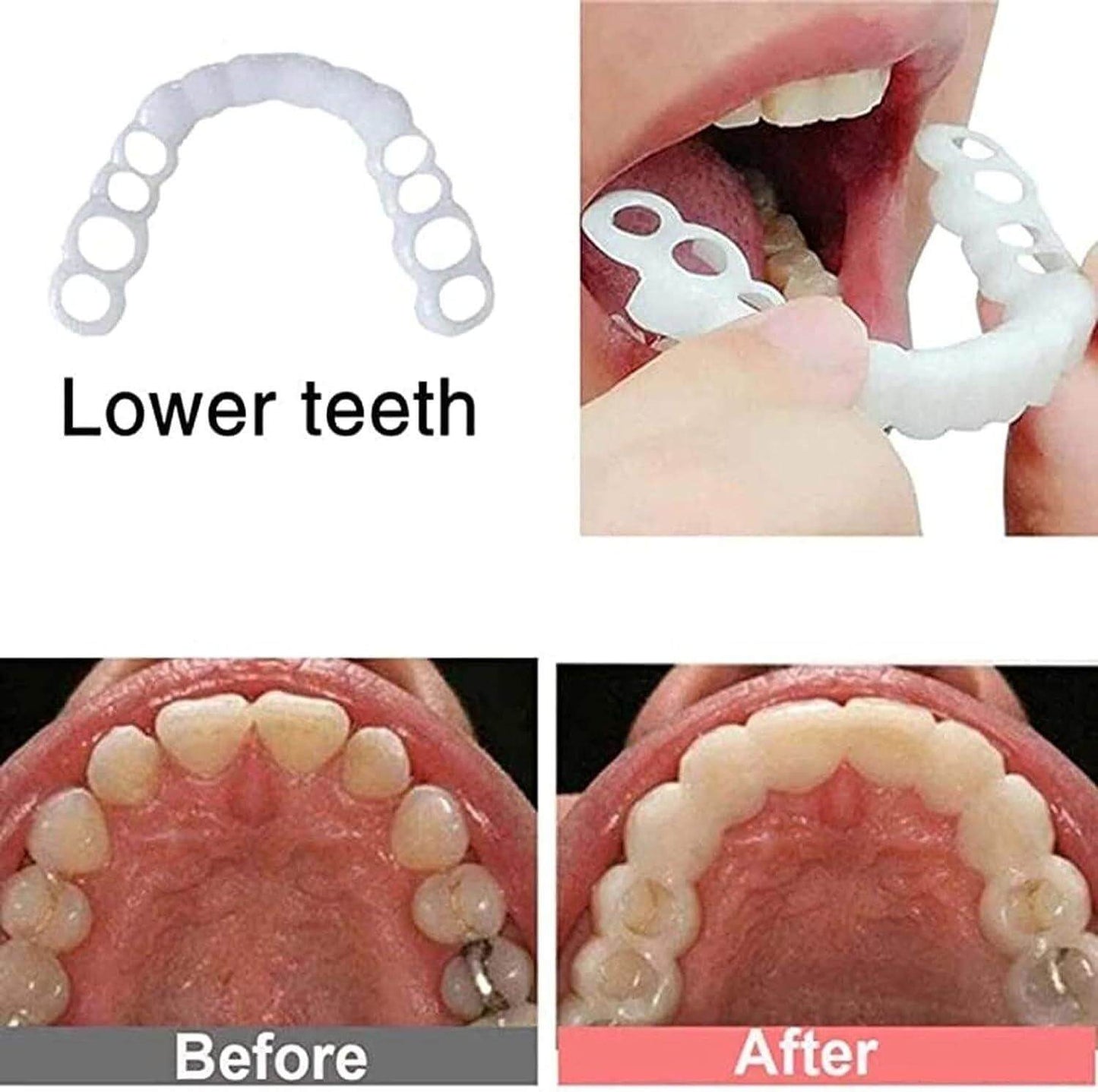 Reusable Temporary Denture Teeth